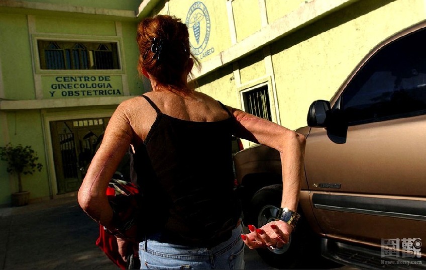 La cirugía plástica barata y sucia de las estadounidenses