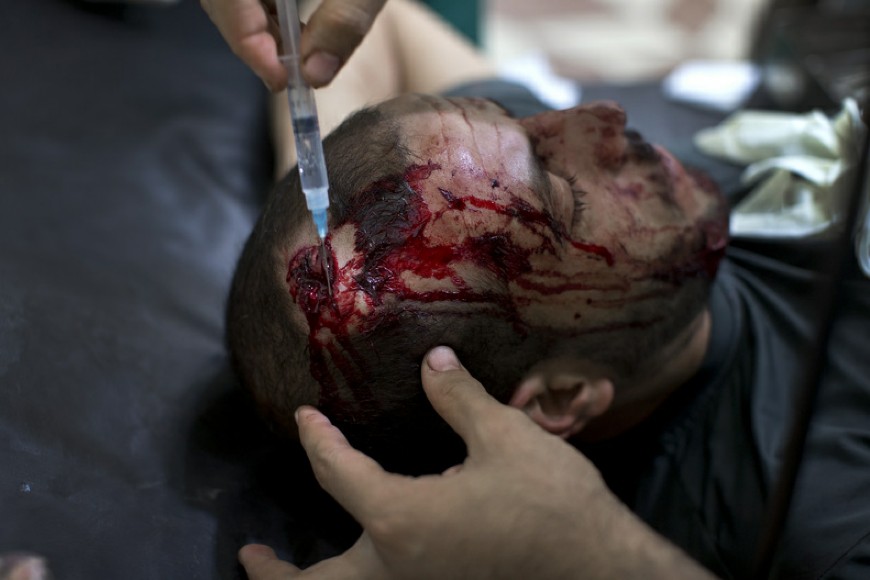  La cabeza del hombre alcanzaba por la bala, afortunadamente no amenazó la vida. El médico sacó la bala de su cabeza y dos horas después, él y su hermano estaban sentados fuera del Hospital Dar al Shifaa. Le dolía muchísimo. 這名男子頭部被子彈擊中，但幸運的是，并沒有生命危險。醫(yī)生為他從頭骨中取出了子彈，