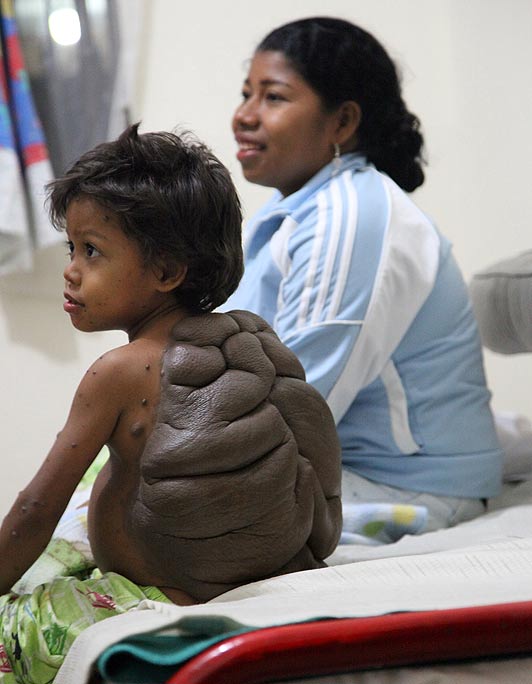 congenital melanocytic nevus