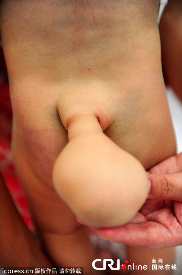 Un niño chino de siete meses nacido con ‘cola’