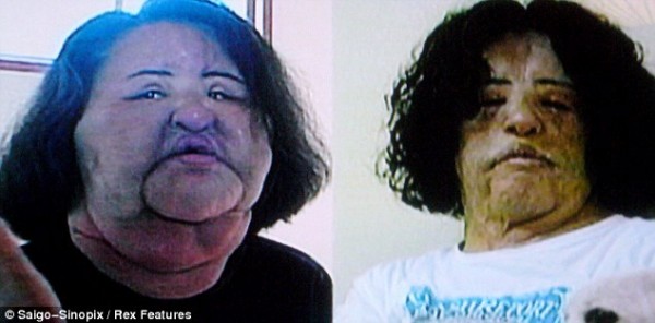 Modelo surcoreana quedó desfigurada por inyectar aceite en su rostro 1