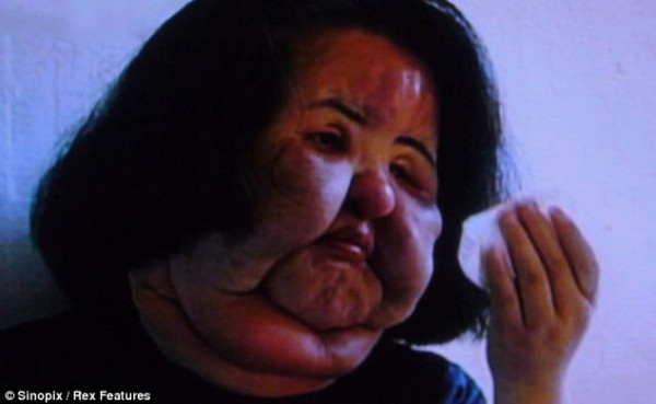 Modelo surcoreana quedó desfigurada por inyectar aceite en su rostro 5