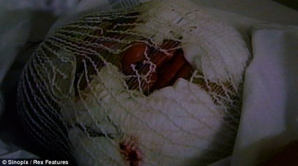 Modelo surcoreana quedó desfigurada por inyectar aceite en su rostro 56