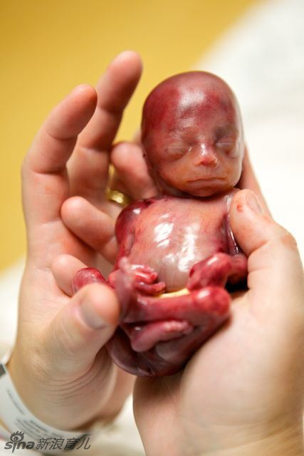 Fotos horribles de un feto muerto de 18 semanas 