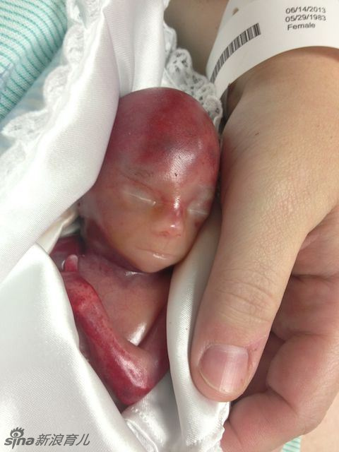 Fotos horribles de un feto muerto de 18 semanas 