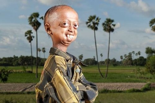 Ali Hussain, el niño de 14 años con cuerpo de hombre de 110 años
