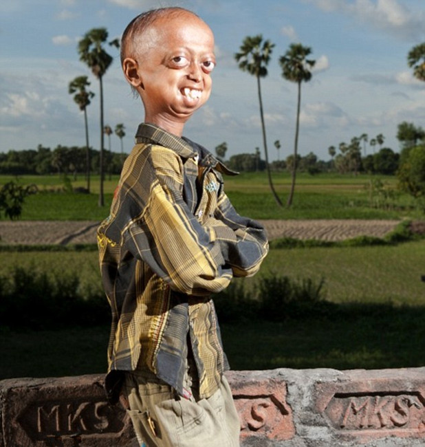 El niño de 14 años con cuerpo de 110 años