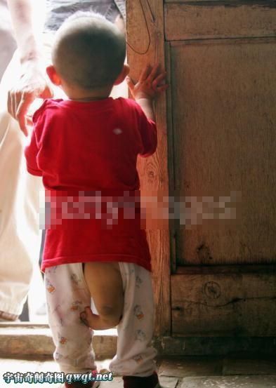 Las personas raras que cuentan con tres piernas en la historia humana 