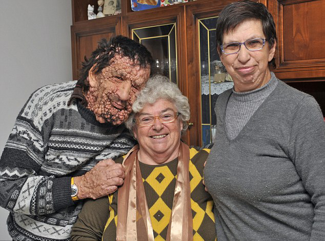 Vinicio Riva, el pobre hombre con neurofibromatosis por su cuerpo