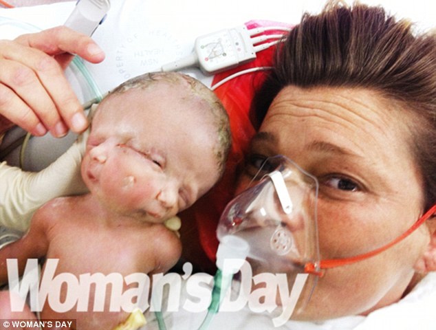 Nace un bebé con dos caras en Australia 