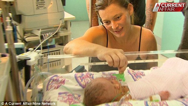 Nace un bebé con dos caras en Australia 