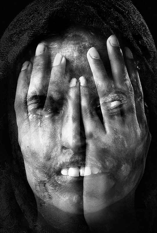 Impresionantes fotografías documentales reflejan la vida de las víctimas del ácido sulfúrico4