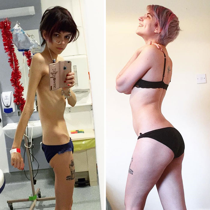 Antes y Después de Pics de personas quienes han derrotado la anorexia