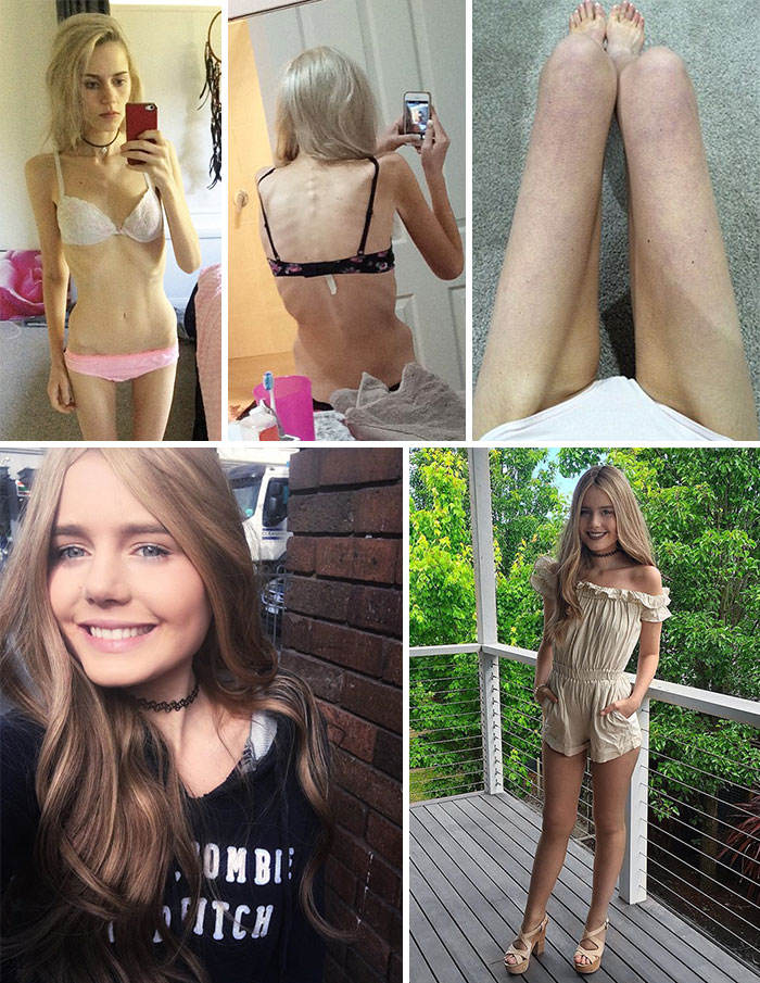 Antes y Después de Pics de personas quienes han derrotado la anorexia