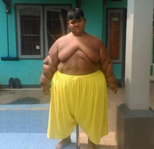 Arya Permana, el niño más obeso del mundo6