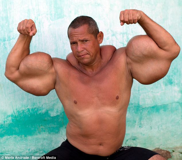 Hombre brasileño usa substancia especial para convertirse exageradamente musculoso6