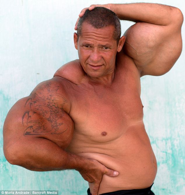 Hombre brasileño usa substancia especial para convertirse exageradamente musculoso4