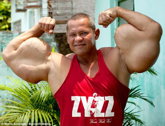 Hombre brasileño usa substancia especial para convertirse exageradamente musculoso3