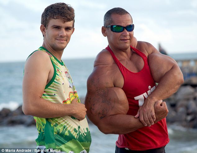 Hombre brasileño usa substancia especial para convertirse exageradamente musculoso2