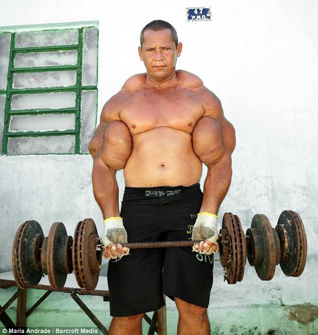 Hombre brasileño usa substancia especial para convertirse exageradamente musculoso1