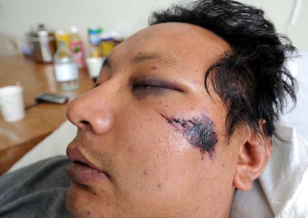 A person who was wounded during the unrest in Lhasa receives medical treatment in a hospital in Lhasa, capital of southwest China's Tibet Autonomous Region, in this photo taken on March 16, 2008. (Xinhua Photo)