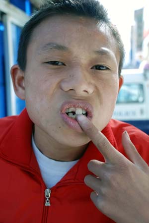 Luo Jie shows his tooth broken during the March 14 riots to journalists in Lhasa, capital of southwest China's Tibet Autonomous Region, on March 31, 2008. Luo Jie, a 14-year-old native Lhasa boy, told journalists on Sunday that the caption of a photo in a western website is totally wrong by saying he was arrested by Chinese police, the truth is that he was rescued by Chinese police after he was attacked by rioters on a street near Ramoqe Temple in the March 14 Lhasa riots. 