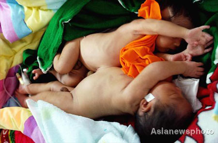 Four-day-old conjoined twin boys are seen sleeping at the Children’s Hospital in Zhengzhou, capital of Central China’s Henan Province, November 5, 2008. The twins are joined from their chests to the bellybutton, but they are in stable condition. The hospital will further examine the twins to see whether they share any organs and how to separate them.
