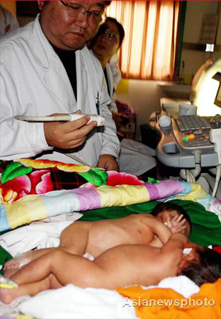 A surgeon examines four-day-old conjoined twin boys at the Children&apos;s Hospital in Zhengzhou, capital of Central China&apos;s Henan Province, November 5, 2008. The twins are joined from their chests down to the bellybutton, but they are in stable condition. The hospital will further examine the twins to see whether they share any organs and how to separate them.