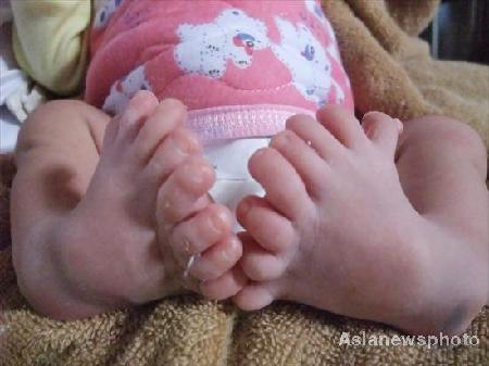 A baby boy with eight toes on each foot was discharged from a hospital in Leizhou, southeast Guangdong province on November 5, 2008. The baby has five fingers on each hand but doesn't have thumbs. Doctor said this might have something to do with genetics or environment pollution. [Photo: Asianewsphoto]