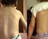 Swiss scientists have made good progress toward treating spinal muscular atrophy (SMA), one of the leading genetic causes of early childhood death, the official Swissinfo news website reported Friday.