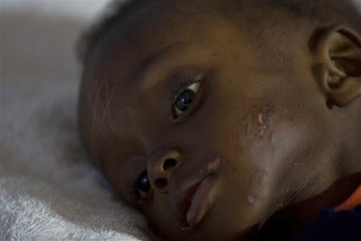 Pierre Davidson, 3, who suffers from malnutrition, lies on a bed at the Doctors Without Borders hospital in Port-au-Prince, Wednesday, Nov. 19, 2008. 