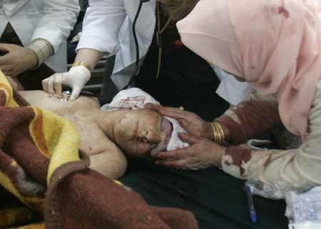 A child who was wounded in a bomb attack receives treatment in a hospital in Kirkuk, 250 km (155 miles) north of Baghdad December 11, 2008. The death toll from suicide bomb attack at a restaurant in Kirkuk on Thursday rose to 47 and some 93 others injured, a local police source said. 