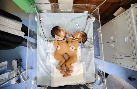 Conjoined twins wait for a thorough examination in the intensive care unit at the Children's Hospital of Hunan Province in Changsha, capital of central-south China's Hunan Province, March 19, 2009. The twins born on March 16 in Xinhua County of the province weigh 4.8 kilograms and are connected by abdomen. Doctors of the Children's Hospital of Hunan Province would give them a thorough examination and find a way to do the separation surgery. [Xinhua]