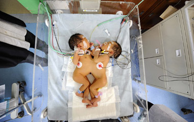 Conjoined twins wait for a thorough examination in the intensive care unit at the Children's Hospital of Hunan Province in Changsha, capital of central-south China's Hunan Province, March 19, 2009. The twins born on March 16 in Xinhua County of the province weigh 4.8 kilograms and are connected by abdomen. Doctors of the Children's Hospital of Hunan Province would give them a thorough examination and find a way to do the separation surgery. [Xinhua]
