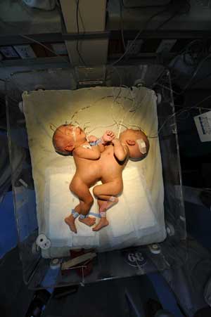 The conjoined twins are seen before the separation surgery at Hunan Children's Hospital in Changsha, capital of central China's Hunan Province, April 1, 2009. 