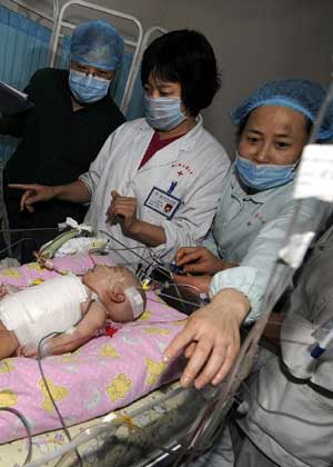 One of the conjoined twins is attended after the separation surgery at Hunan Children's Hospital in Changsha, capital of central China's Hunan Province, April 1, 2009.