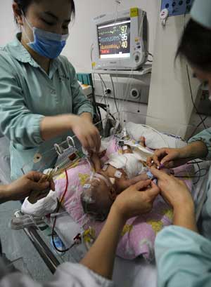 One of the conjoined twins is attended after the separation surgery at Hunan Children's Hospital in Changsha, capital of central China's Hunan Province, April 1, 2009. 