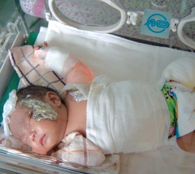 A 24-day-old baby was seriously burned in a hospital in Hubei Province after falling off a table onto a heater, today's Changjiang Times reported.