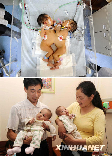 The combo photo shows that (upper) the siamese twin sisters receive medical check-ups at the Hunan Children's Hospital on March 19, 2009; (lower) parents hold the separated siamese twin sisters in arms before they check out at the Hunan Children's Hospital in Changsha, capital of central China's Hunan Province, June 18, 2009. The separated siamese twin sisters left the hospital on Thursday after fully recovered from the surgery. [Li Ga/Xinhua]