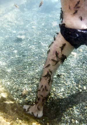 Garra rufa obtusas, also known as "doctor fish", nibble on the skin of a psoriasis patient in a hot spa pool in Kangal, 105 kilometers (65 miles) south of the central Anatolian city of Sivas August 9, 2009.