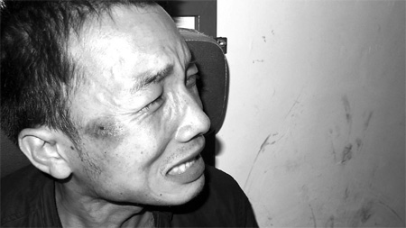 Zhang Jinxing's face is bruised. [China Daily]