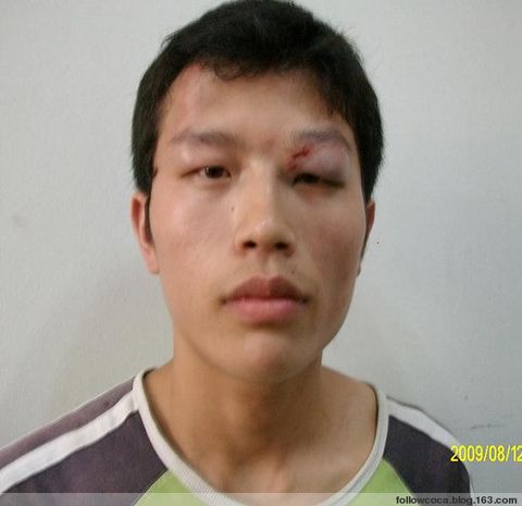  This student member of the Coca Cola Monitoring Group was beaten up by staff of a contract labor firm after taking part in an undercover investigation of working conditions at a bottling plant in Hangzhou. 