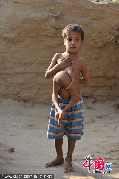 Deepak Kumar Paswaan, a 7-year-old boy living in Buxar, Bihar, eastern India, has a pair of feet growing out of his chest. Some people thus take him as the incarnation of god while others cast stones to him to drive out the &apos;demon&apos; in his body. His parents are trying to find doctors to take away the parasite. [CFP]