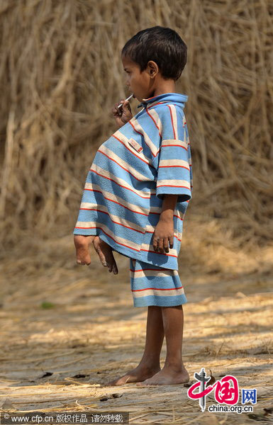 Deepak Kumar Paswaan, a 7-year-old boy living in Buxar, Bihar, eastern India, has a pair of feet growing out of his chest. [CFP]