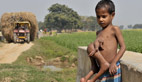 Indian boy has feet growing out of chest