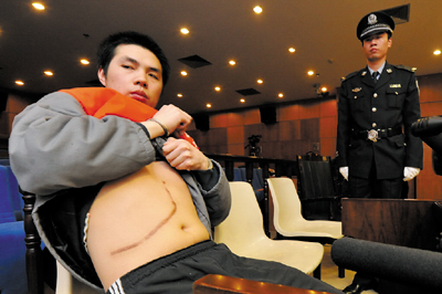 Organ trafficking middleman Liu Qiangshen sits in the court showing his side scar left after a liver transplantation operation. [Beijing Morning Post]