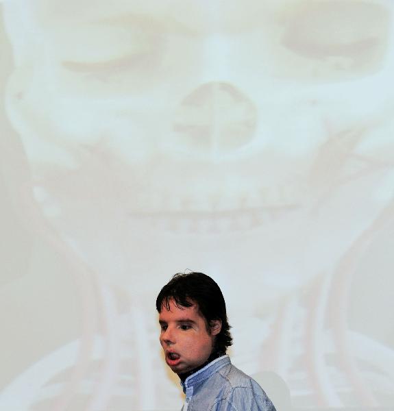 Oscar, the world first full-face transplant patient, poses for the photographers as he attends a news conference at the Vall d&apos;Hebron Hospital in Barcelona July 26, 2010. Oscar, who underwent the transplant in April by a 30-member medical team led by Spanish doctor Juan Barret, accidentally shot himself in the face five years ago.[Xinhua]