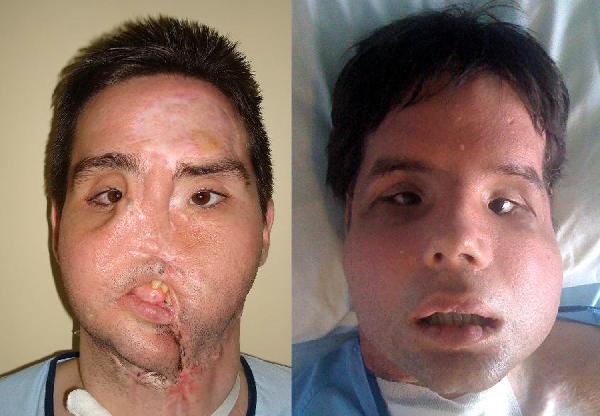 Oscar, a man who underwent a full-face transplant in April appears before, left, and after, right, the surgery at the Vall d&apos;Hebron Hospital in Barcelona, Spain.[Xinhua]