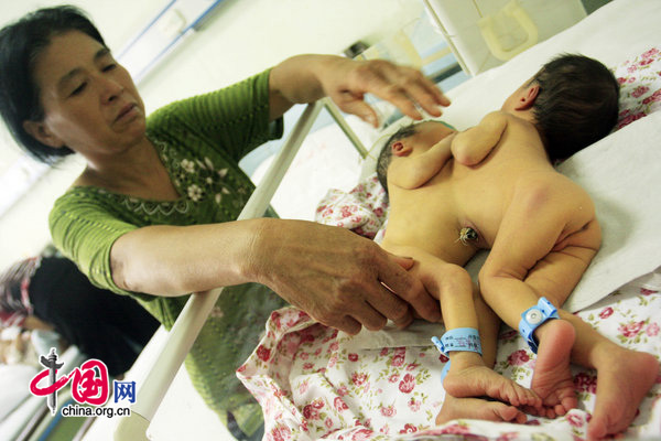 Jing Lerong looks at her newly born grandchildren, conjoined twin girls, at the Shandong Provincial Hospital in Jinan, East China&apos;s Shandong province, Sept 7, 2010. The conjoined twin girls were born on Sept 1 and weighted 3.8 kilograms. Doctors are making a comprehensive check on the babies before deciding to separate them, local media reported. [CFP]