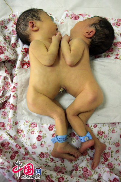 Conjoined twin girls rest at the Shandong Provincial Hospital in Jinan, East China&apos;s Shandong province, Sept 7, 2010. [CFP]